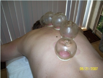 Cupping foto